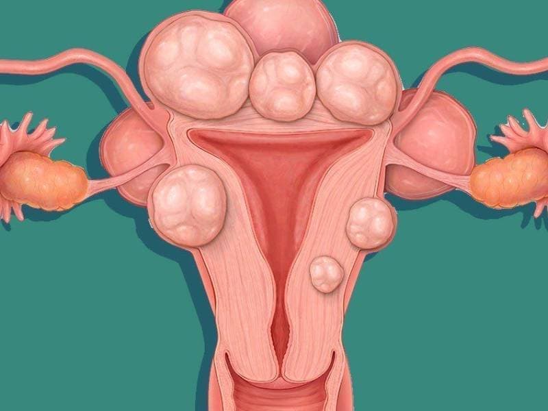 Uterine Fibroid
