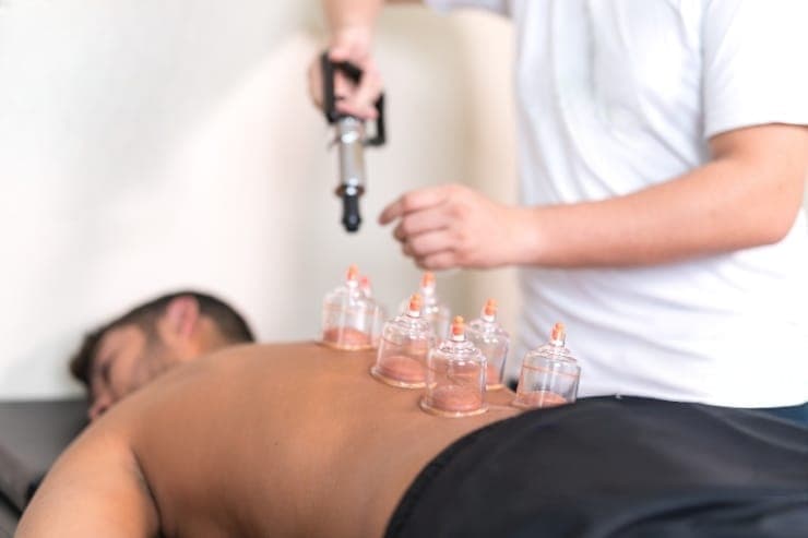 Hijama (Cupping Therapy)