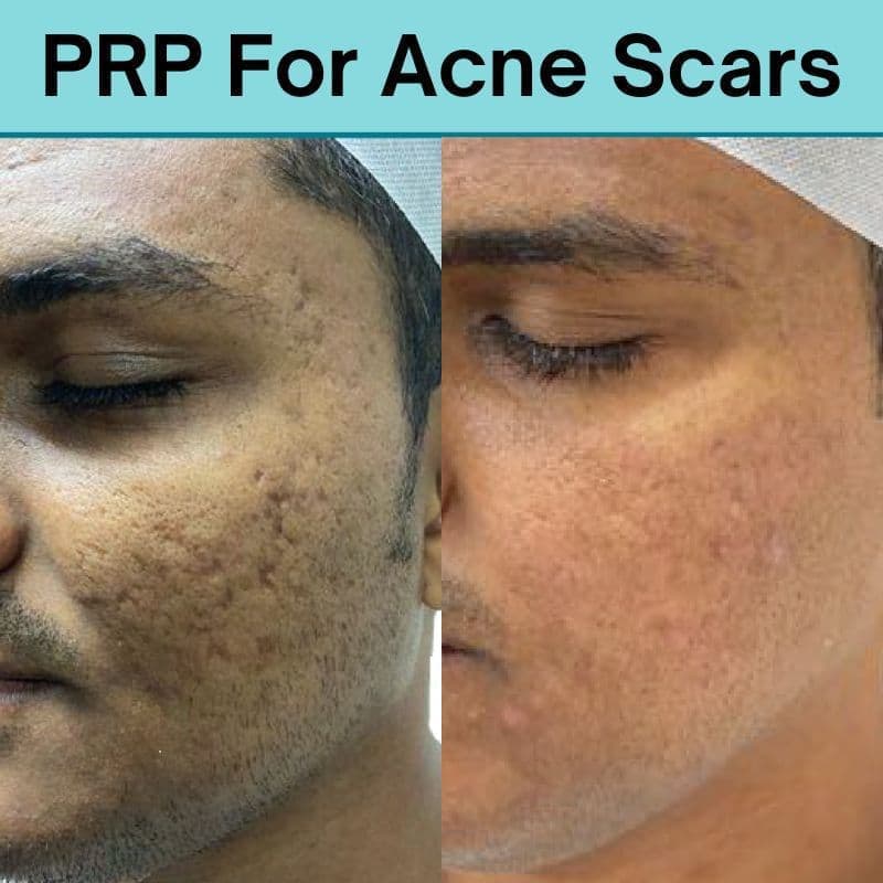 Acne Scars