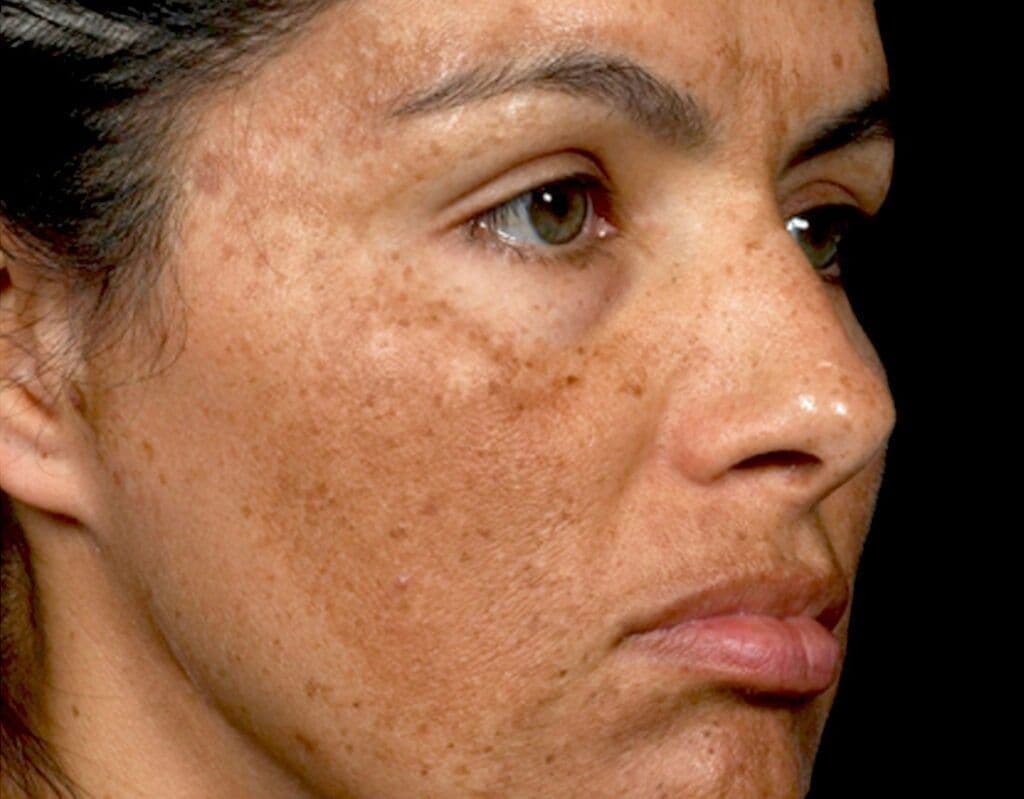 Melasma