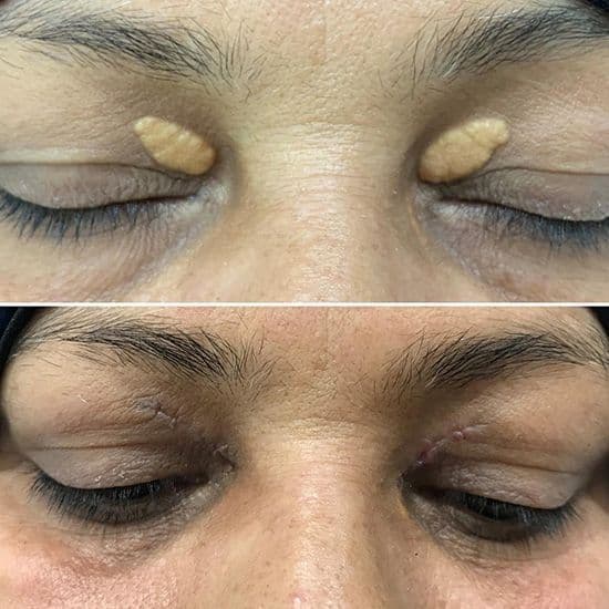 Xanthelasma